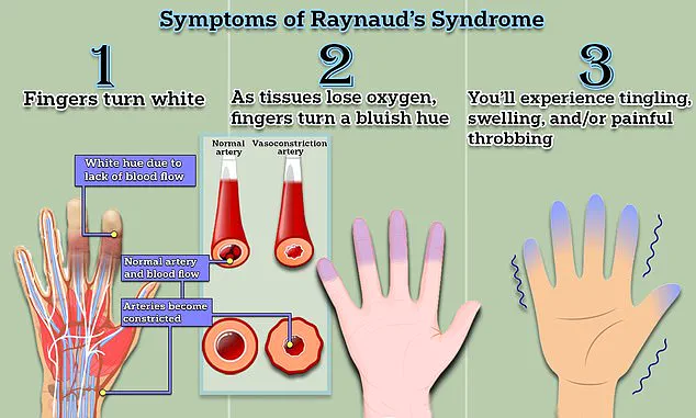 Scientists Identify Potential Breakthrough in Treating Raynaud's Disease, a Condition Affecting Hundreds of Millions Worldwide