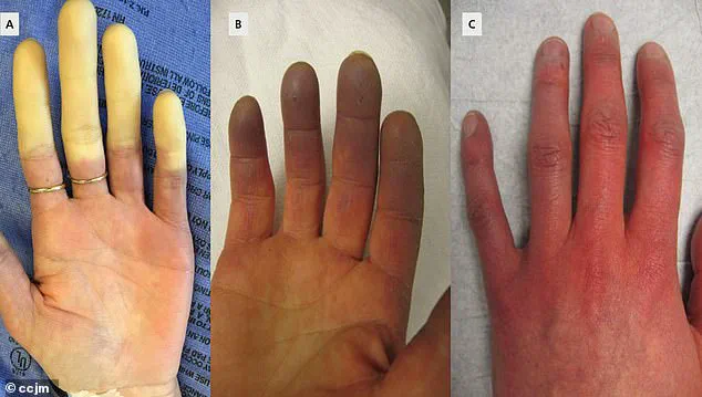 Scientists Identify Potential Breakthrough in Treating Raynaud's Disease, a Condition Affecting Hundreds of Millions Worldwide