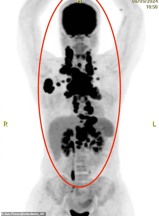 24-Year-Old Brazilian Mother Diagnosed with Rare B-Cell Non-Hodgkin Lymphoma After Rapid Weight Loss