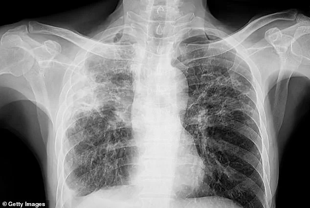 Maine's Public Health Efforts Intensify Following Three Tuberculosis Cases, as WHO Labels Disease Deadliest Globally