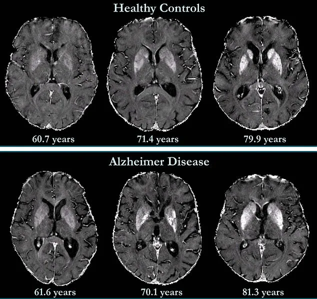 Breakthrough in Early Dementia Detection: New Brain Imaging Technique Predicts Disease Decades in Advance