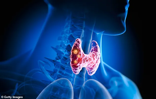 Exclusive Insights: Why Some Hypothyroidism Patients May Require More Than Standard Thyroxine Treatment