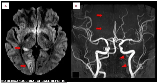 Late-Breaking Alert: Nintendo Ring Fit Adventure Linked to Stroke in 25-Year-Old Woman