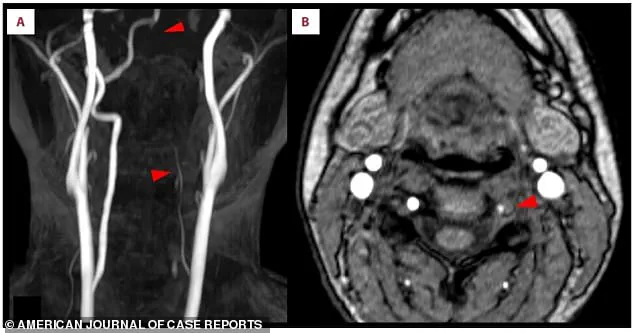 Late-Breaking Alert: Nintendo Ring Fit Adventure Linked to Stroke in 25-Year-Old Woman