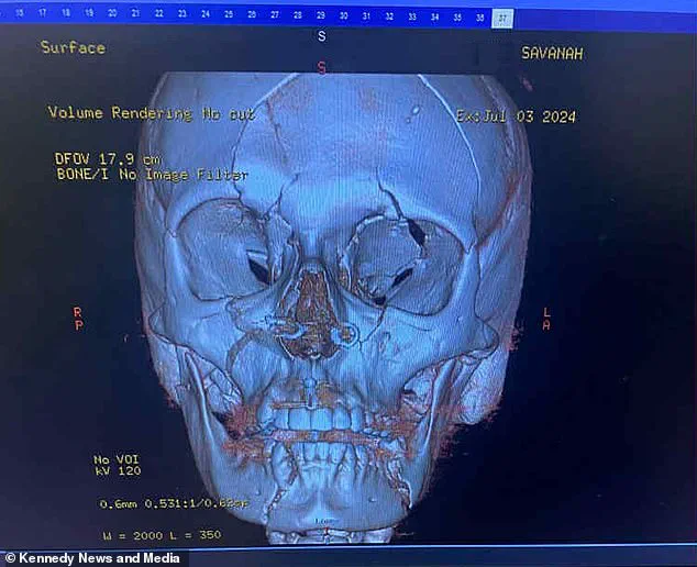 Mother Survives Horrific E-Scooter Accident as Community Grapples with Safety Risks