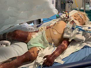 Study Reveals Type 2 Diabetes Doubles Sepsis Risk for 1 in 10 Americans, Sparking Urgent Health Alerts