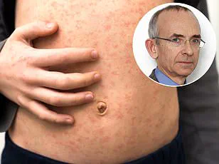 Tragic Case Highlights Long-Term Dangers of Measles Resurgence and Urges Vaccination, Says Public Health Officials