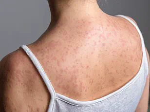 Measles Outbreak Declared Over in Texas as Nationwide Surge Sparks Public Health Concerns