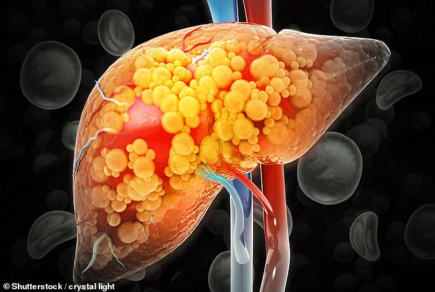 Medical Breakthrough: Common Medications May Reverse Rising Liver Disease in UK