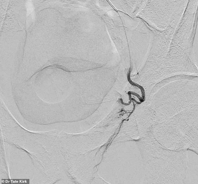 Late-Breaking Alert: BPH Treatment Challenges Intensify as Prevalence Surpasses 50% in Men Over 50