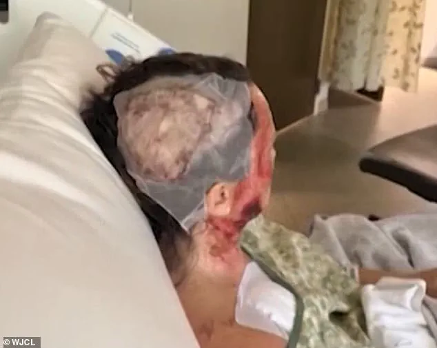 Georgia Woman Suffers Acid Attack in Savannah, Faces Disfigurement and Medical Bills