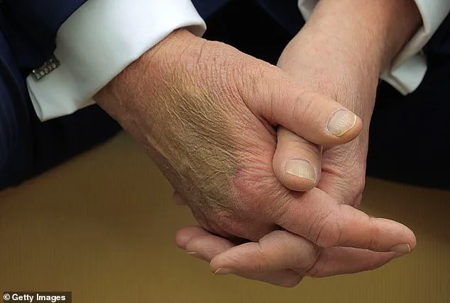 President Trump's Daily Aspirin Regimen for Cardiac Prevention: A Common Practice Among 30 Million Americans