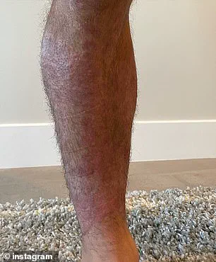 Chad Mendes' Struggle with Psoriasis: A Chronic Autoimmune Condition and the Limits of Conventional Treatments