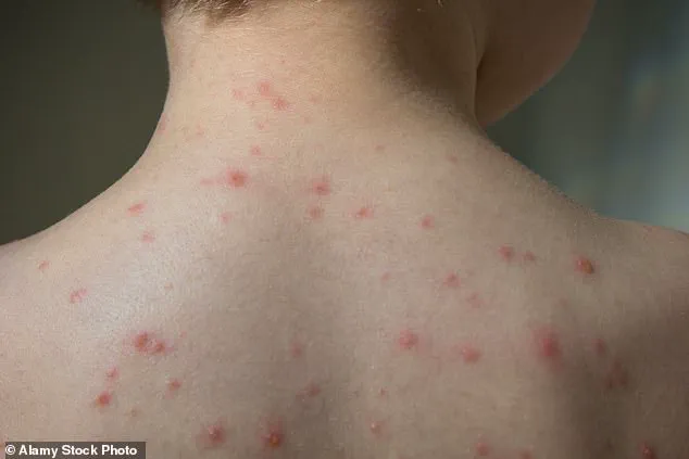 Chickenpox's Unexpected Impact: A Child's Health Journey and Family's Challenge