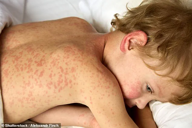 Measles Outbreak Sparks Public Health Alert at Four Major U.S. Airports During Holiday Season