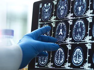 Youngest Alzheimer’s Case in China Sparks Concern Over Early-Onset Dementia Diagnosis and Public Health Implications