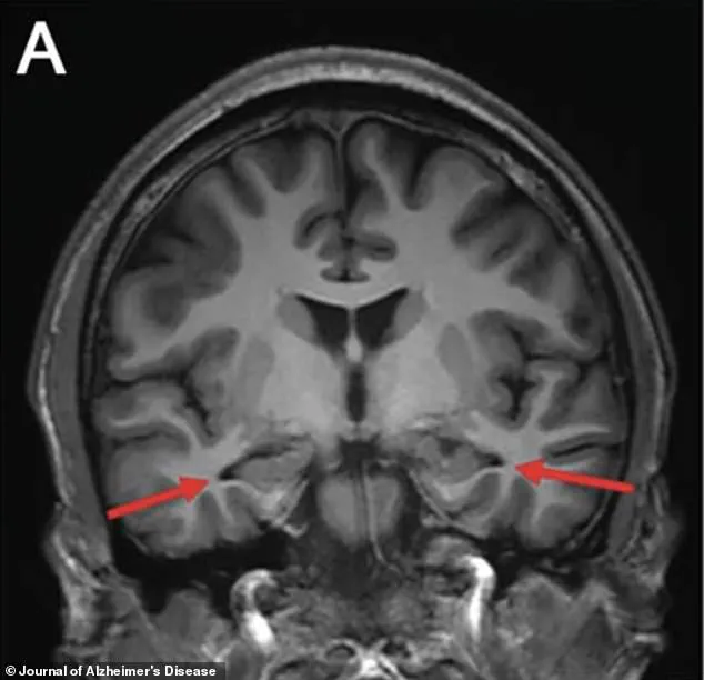 Youngest Alzheimer’s Case in China Sparks Concern Over Early-Onset Dementia Diagnosis and Public Health Implications