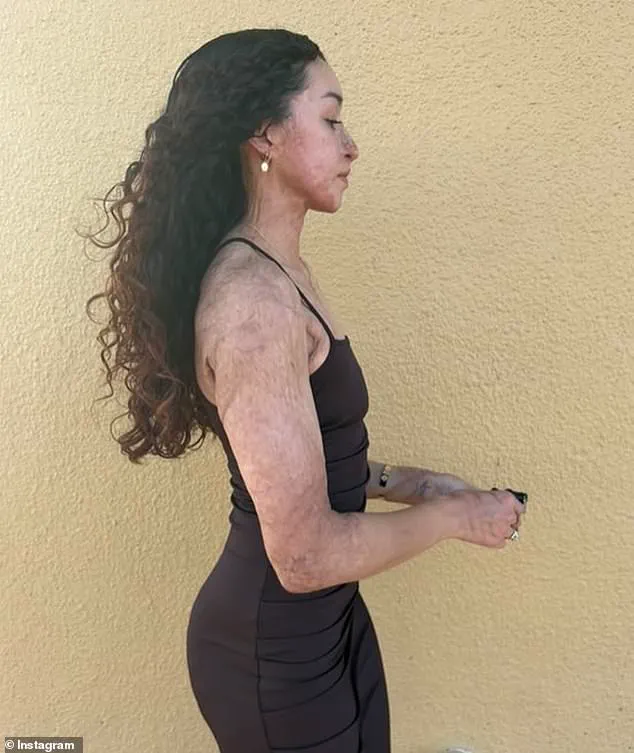 Bodybuilder Survives Shooting and Acid Attack in Hawaii, Suffering 30% Third-Degree Burns