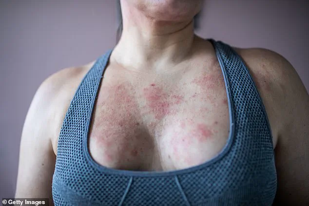 Late-Breaking: Tracy Owen's Eczema Deteriorates as Menopause Complicates Management