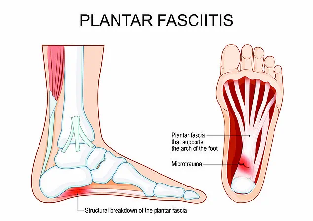 Plantar Fasciitis: A Condition on the Rise Among Runners and the Aging Population