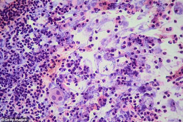 Deadly Tuberculosis Outbreak Escalates at Archbishop Riordan High School, Third Case Confirmed by SFDPH