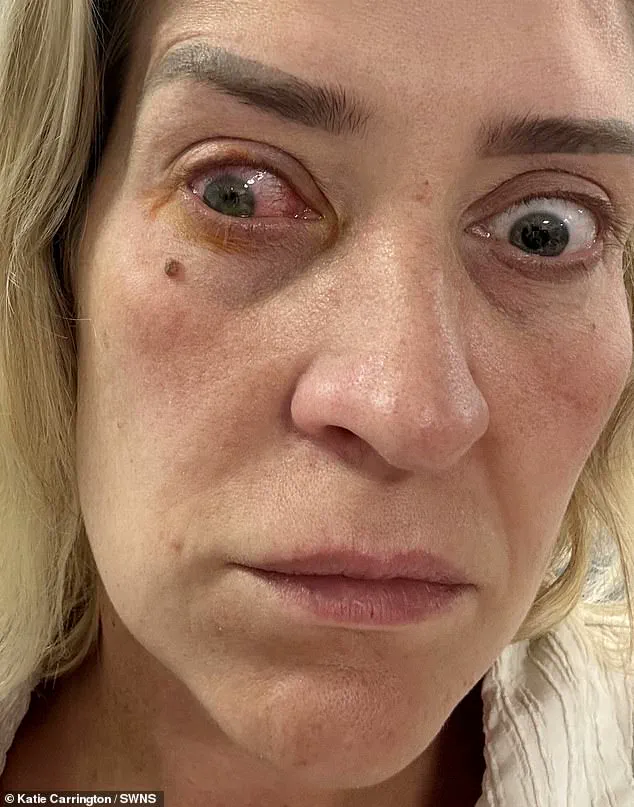 Blindness from Overwearing Contact Lenses: A Health Warning