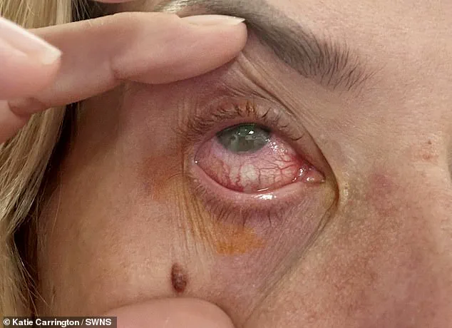 Blindness from Overwearing Contact Lenses: A Health Warning