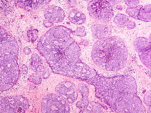 How a Dog's Behavior Led to Early Detection and Survival from Triple-Negative Breast Cancer