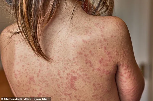 New Measles Case at Disney Parks Raises Health Alert as Virus Resurgence Fears Grow