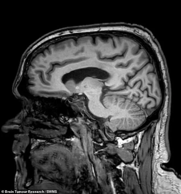 Hidden Brain Tumor Misdiagnosed as Hormonal Imbalance: A Father's Struggle with Glioblastoma