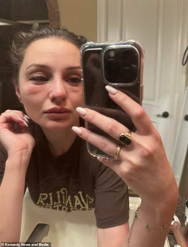 Mercedes Brooke's Hair Loss and the Alarming Symptoms That Followed