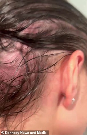 Mercedes Brooke's Hair Loss and the Alarming Symptoms That Followed