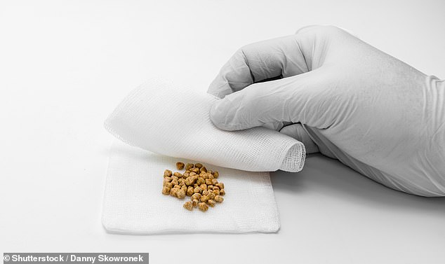 Landmark Study Reveals Cheese Intake Linked to 26% Lower Gallstone Risk