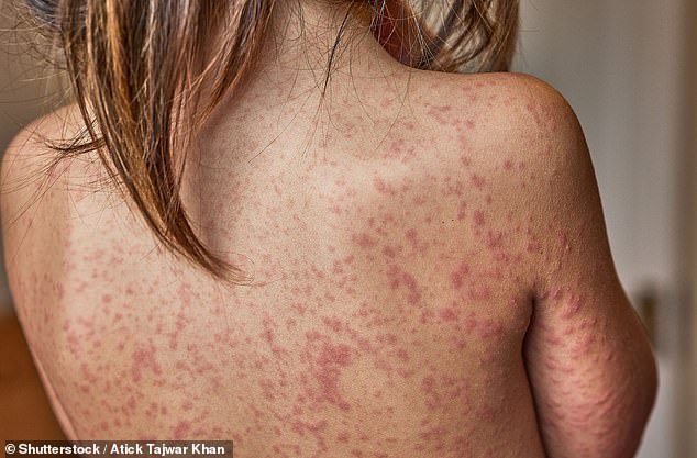 Measles Outbreak in Enfield Sparks Fears of Citywide Epidemic as Cases Double and Health Officials Urge Immediate Action