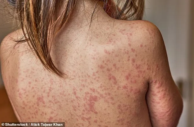 Measles Outbreak in Enfield Sparks Fears of Citywide Epidemic as Cases Double and Health Officials Urge Immediate Action