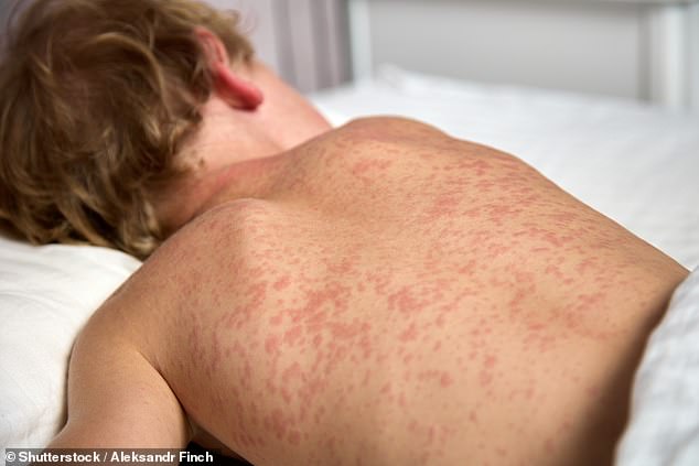 Measles Outbreak in Utah High Schools: Unvaccinated Student Exposed Thousands