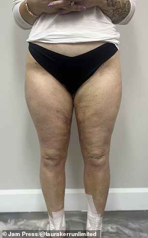 From Isolation to Diagnosis: Laura Kerr's Journey with Lipedema
