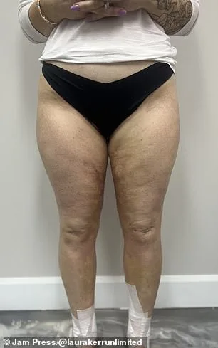 From Isolation to Diagnosis: Laura Kerr's Journey with Lipedema
