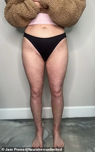 From Isolation to Diagnosis: Laura Kerr's Journey with Lipedema