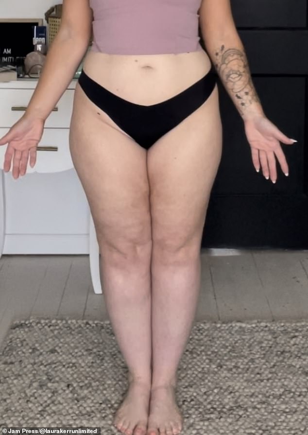 From Isolation to Diagnosis: Laura Kerr's Journey with Lipedema
