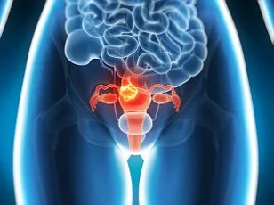 Three-Year Delay in Vulval Cancer Diagnosis Leaves Woman in Agony