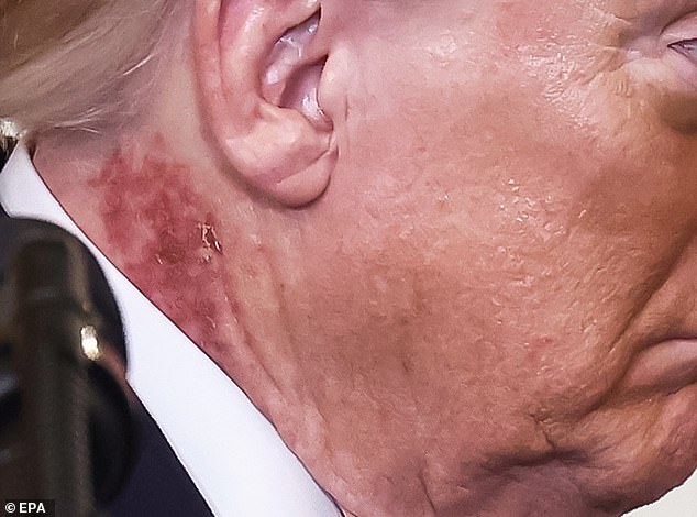 Trump's Neck Rash Sparks Health Concerns and Speculation Over Cause