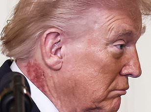 Trump's Neck Rash Sparks Health Concerns and Speculation Over Cause