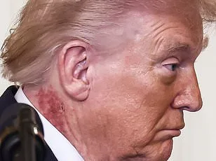 Trump's Neck Rash Sparks Health Concerns and Speculation Over Cause