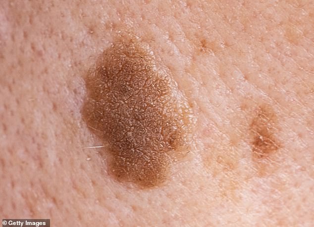 Trump's Neck Rash Sparks Health Concerns and Speculation Over Cause