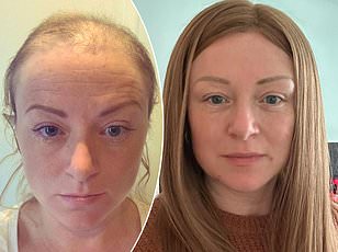 Study Reveals Grey Hair May Be Early Warning Sign for Melanoma