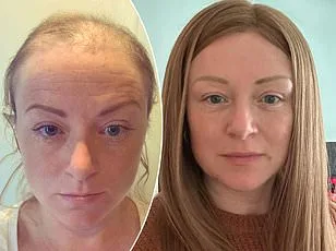 Study Reveals Grey Hair May Be Early Warning Sign for Melanoma