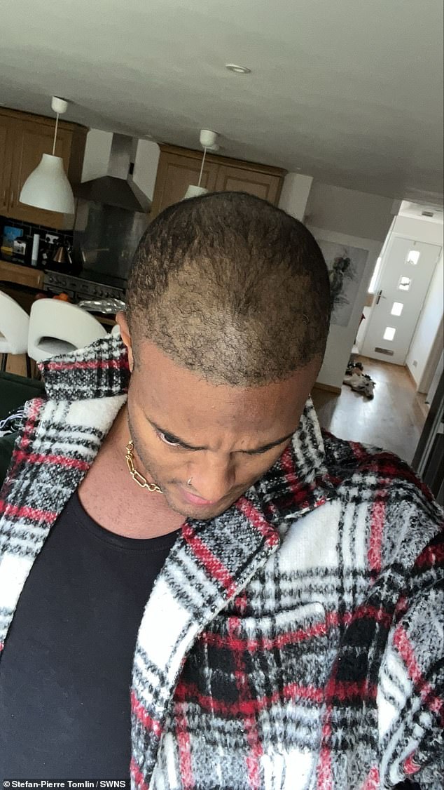 Unveiling 'Mr Tinder': How a Hair Transplant Ended a 20-Year Secret