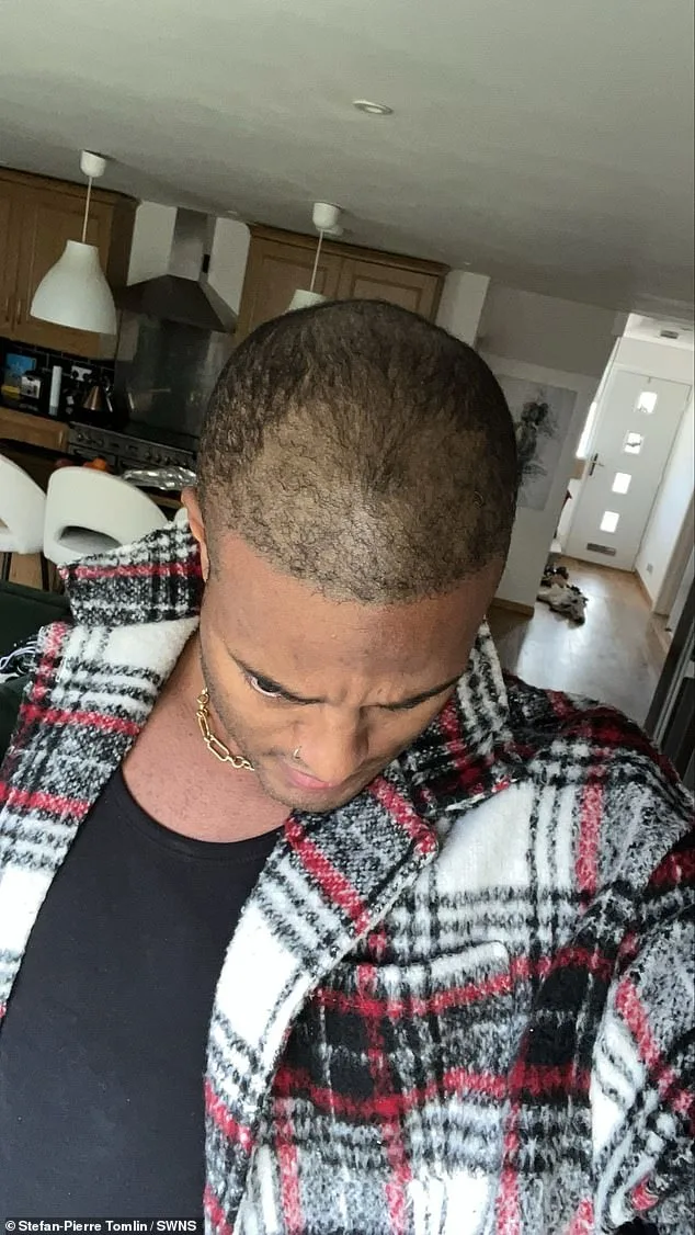 Unveiling 'Mr Tinder': How a Hair Transplant Ended a 20-Year Secret