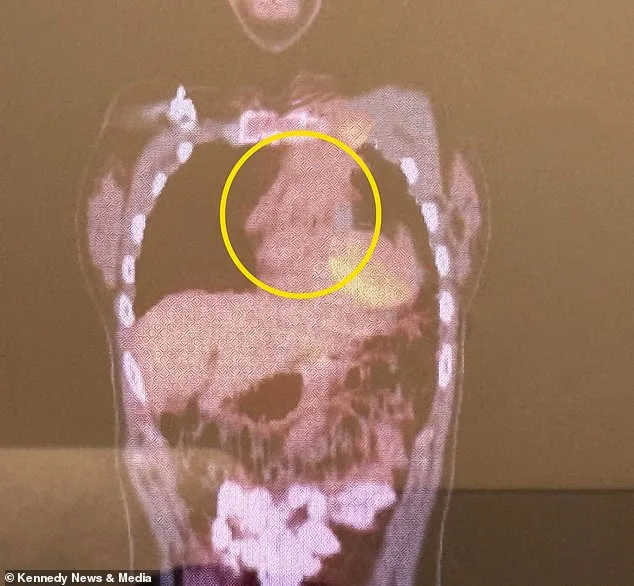 Two Years of Misdiagnosis: How a Student's Symptoms Finally Led to an ER Visit